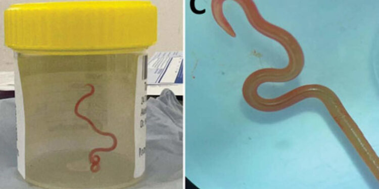 Extraen lombriz intestinal viva de 8 centímetros del cerebro de una australiana