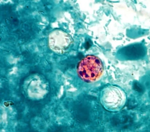 Parásito Ciclosporiasis: Aumentan casos de diarrea grave en NYC y otros estados; dominicanos en alerta